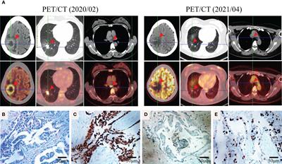 STK3-ALK, a Novel ALK Rearrangement in Non-Small Cell Lung Cancer With Sensitivity to Tyrosine Kinase Inhibitors: A Case Report